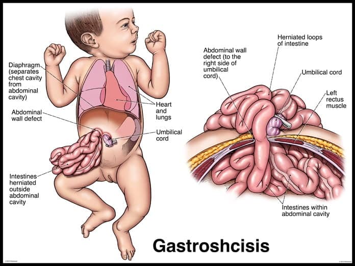 A aflat la naștere că băiețelul are intestinele în afara abdomenului și 10% șanse să trăiască! Poveste relatată de „mămica unui copil malformat” | Demamici.ro