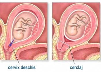 Cerclajul colului uterin. Netratat, poate duce la pierderea sarcinii