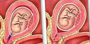 Cerclajul colului uterin. Slăbiciunea uterului poate duce la pierderea sarcinii | Demamici.ro