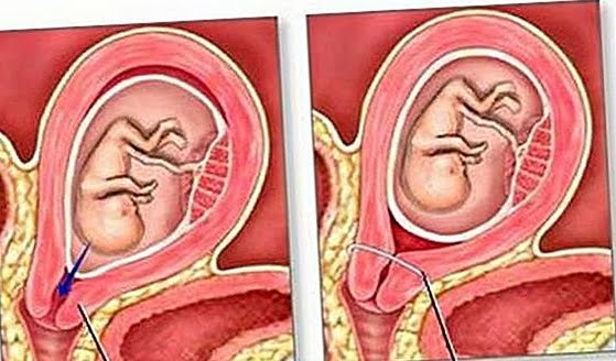 Cerclajul colului uterin. Netratat, poate duce la pierderea sarcinii