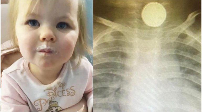 O fetiță de 11 luni a stat 4 luni cu o baterie blocată în gât. Medicii au crezut că are amigdalită | Demamici.ro