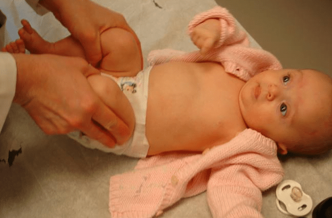 Ecografia de șold la bebeluși. Importanța ei în prevenirea și tratarea displaziei de șold | Demamici.ro