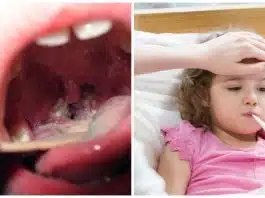 „Boala sărutului” (mononucleoza), la copii. Ce e important să știi despre ea | Demamici.ro