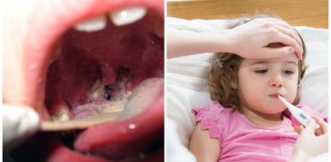 „Boala sărutului” (mononucleoza), la copii. Ce e important să știi despre ea | Demamici.ro