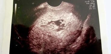 Sarcină molară la o fetiță de 12 ani din Focșani. Fenomen rar care apare o dată la 1000 de cazuri | Demamici.ro