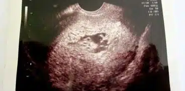 Sarcină molară la o fetiță de 12 ani din Focșani. Fenomen rar care apare o dată la 1000 de cazuri | Demamici.ro
