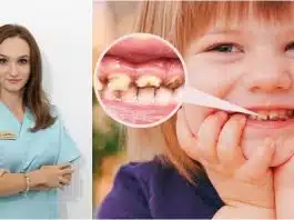 Demineralizarea dinților. Din ce cauză apare, cum o recunoaștem și cum se tratează? Interviu cu Dr. Sfedu Anamaria Virginia – medic pedodont | Demamici.ro