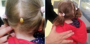 O fetiță din Suceava a ajuns la spital cu o căpușă uriașă prinsă de scalp după s-a jucat în parc | Demamici.ro