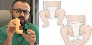 Picioarele strâmbe la naștere? Malformația „Picior varus equin”, explicată de un specialist în Ortopedie Pediatrică VIDEO | Demamici.ro