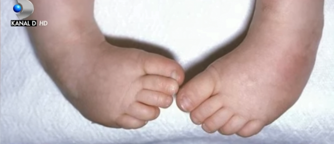 Picioarele strâmbe la naștere? Malformația „Picior varus equin”, explicată de un specialist în Ortopedie Pediatrică VIDEO | Demamici.ro
