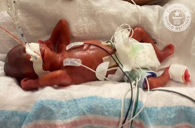 Cel mai mic bebeluș născut prematur. A venit pe lume la 19 săptămâni și cântărea la naștere doar 420 de grame. Cum arată băiețelul în prezent