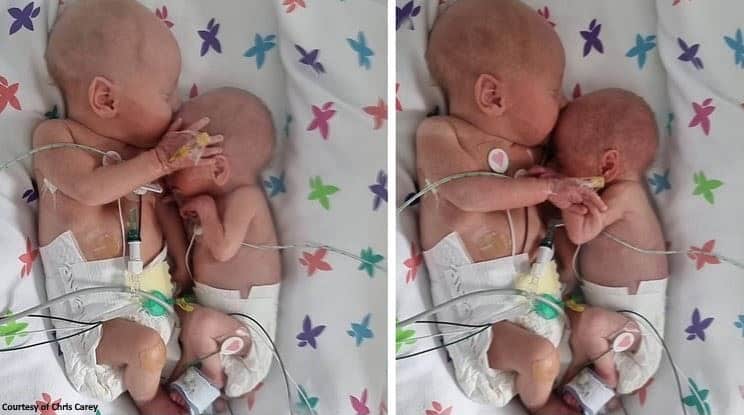 Miracolele există. Surioara mai mică își îmbrățișează fratele geamăn după ce medicii nu-i dădeau nicio șansă la viață