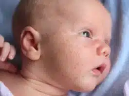 Acneea bebelușului: ce este, tratament și când trebuie să mergi la pediatru! Cum o diferențiezi de eczemă, dermatită sau milia | Demamici.ro