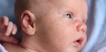 Acneea bebelușului: ce este, tratament și când trebuie să mergi la pediatru! Cum o diferențiezi de eczemă, dermatită sau milia | Demamici.ro