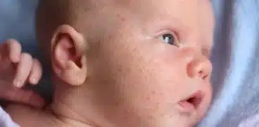 Acneea bebelușului: ce este, tratament și când trebuie să mergi la pediatru! Cum o diferențiezi de eczemă, dermatită sau milia | Demamici.ro