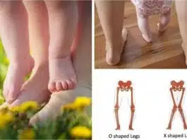 Genu valgum sau genunchii în X la copii: cauze și tratament | Demamici.ro