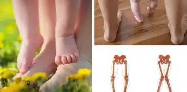 Genu valgum sau genunchii în X la copii: cauze și tratament | Demamici.ro