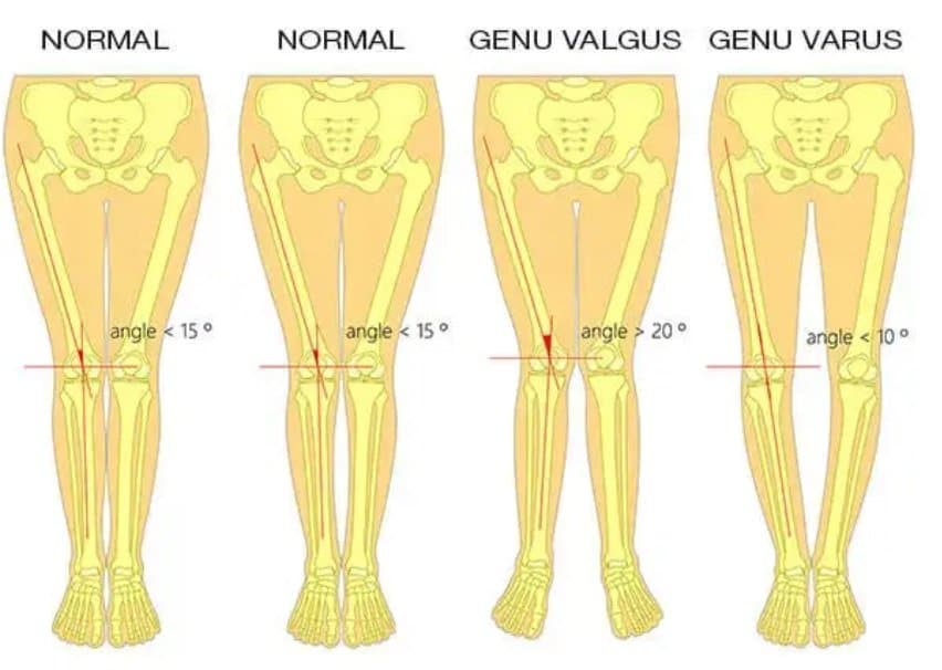 picioare genu valgum