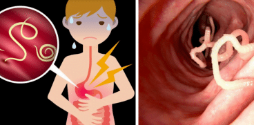 Paraziții intestinali la copii. Care sunt semnele infestării și cum prevenim infecția cu paraziți intestinali | Demamici.ro