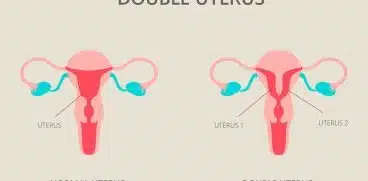 Uterul didelf sau uterul dublu. Cum afectează sarcina | Demamici.ro