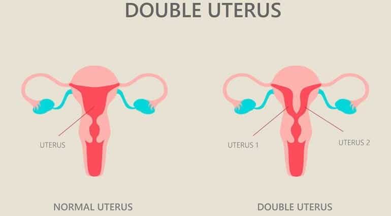 Tot ce trebuie să știi despre uterul didelf. Ce este și cum afectează sarcina