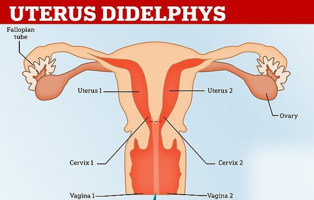 Tot ce trebuie să știi despre uterul didelf. Ce este și cum afectează sarcina
