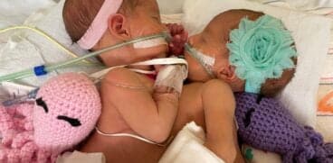 Gemene siameze, separate cu succes după o operație de 10 ore: „Acum se uită una la cealaltă și își zâmbesc!” | Demamici.ro