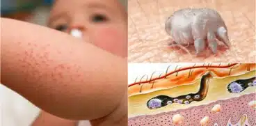 Scabia (râia) la copii. Cum să o recunoști încă de la primele semne. Cauze, simptome, tratament | Demamici.ro