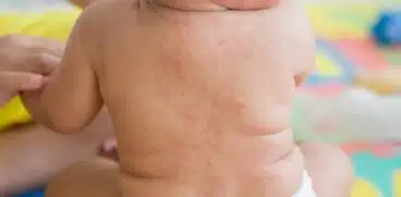 Roseola infantum: ce este, cum se manifestă și care este tratamentul | Demamici.ro