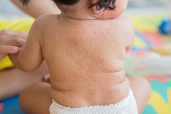 Roseola infantum: ce este, cum se manifestă și care este tratamentul | Demamici.ro