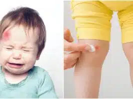 Sfaturi utile în cazul vânătăilor la copii. Care este diferența dintre echimoză și hematom | Demamici.ro