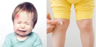 Sfaturi utile în cazul vânătăilor la copii. Care este diferența dintre echimoză și hematom | Demamici.ro