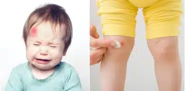Sfaturi utile în cazul vânătăilor la copii. Care este diferența dintre echimoză și hematom | Demamici.ro