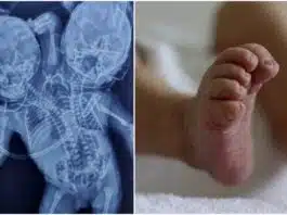 Bebeluș născut cu două capete, trei mâini și două inimi. Mama credea că va avea gemeni | Demamici.ro