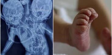 Bebeluș născut cu două capete, trei mâini și două inimi. Mama credea că va avea gemeni | Demamici.ro