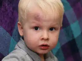 Cucuiul (hematomul) la copii. Simptome care indică o lovitură gravă la cap | Demamici.ro