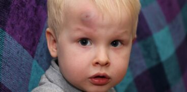 Cucuiul (hematomul) la copii. Simptome care indică o lovitură gravă la cap | Demamici.ro