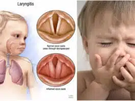 Laringita virală – cauze, simptome, tratament. Când trebuie să ajungi la medic | Demamici.ro