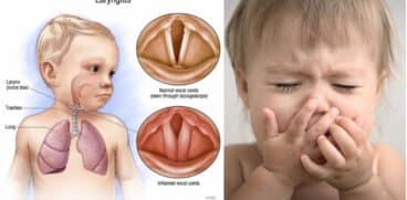 Laringita virală – cauze, simptome, tratament. Când trebuie să ajungi la medic | Demamici.ro