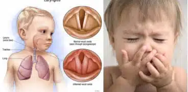 Laringita virală – cauze, simptome, tratament. Când trebuie să ajungi la medic | Demamici.ro