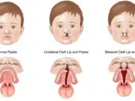 Palatoschizis sau gura de lup: cauze și tratament | Demamici.ro