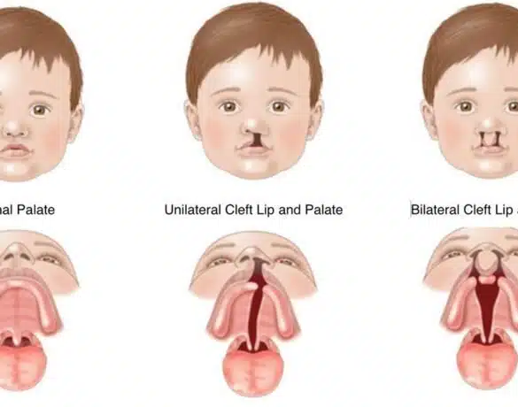 Palatoschizis sau gura de lup: cauze și tratament | Demamici.ro