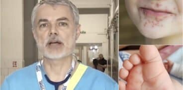 Dr. Mihai Craiu, despre boala mână-gură-picior: „începe ca toate virozele cu febră și gât roșu” | Demamici.ro
