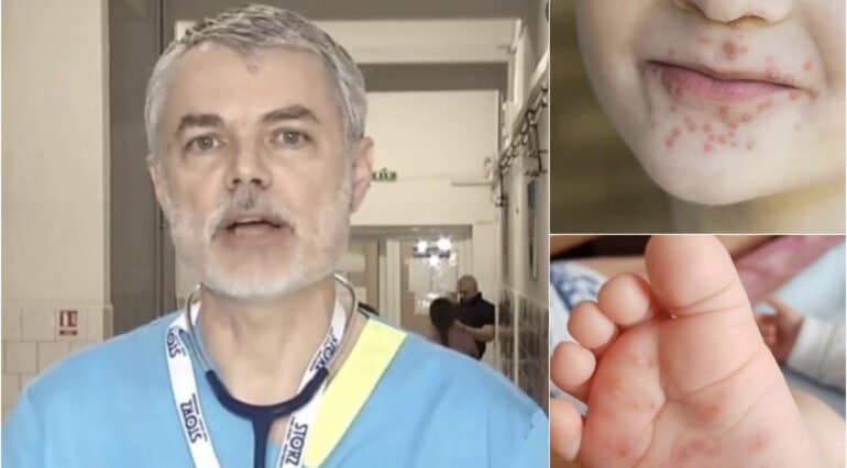 Dr. Mihai Craiu, despre boala mână-gură-picior: „începe ca toate virozele cu febră și gât roșu” | Demamici.ro