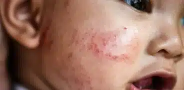 Alergiile la copii. Tipuri de alergii și particularități | Demamici.ro