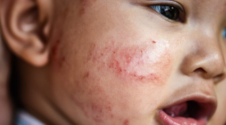 Alergiile la copii. Tipuri de alergii și particularități | Demamici.ro