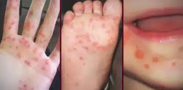 Boala „gură-mână-picior” face ravagii în grădinițe și creșe. Au fost sesizate sute de cazuri | Demamici.ro