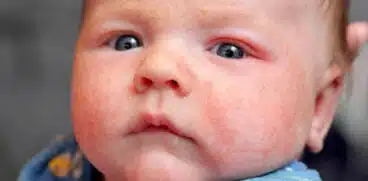 Miliaria sau bubițe de la căldură la copii. Cum pot fi prevenite | Demamici.ro