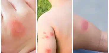 Înțepăturile de albine, viespe și furnici la copii! Când trebuie să mergeți la doctor | Demamici