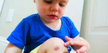 Mușcături de păianjen la copii! Când trebuie să mergeți de urgență la medic | Demamici.ro